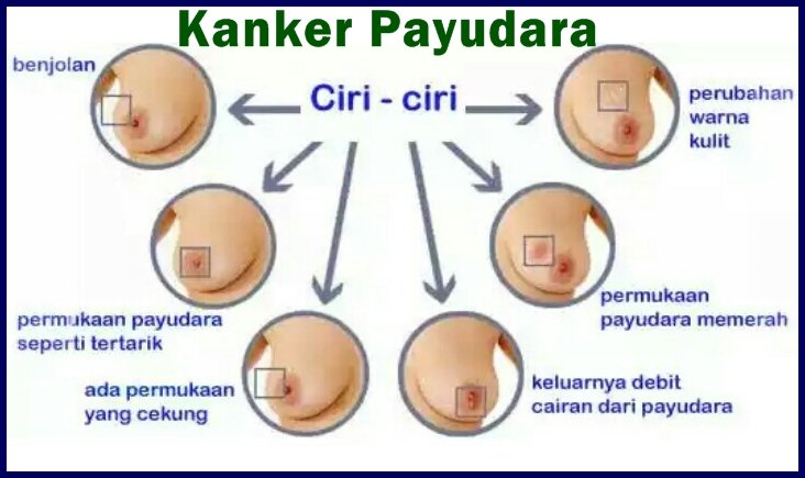 Pengertian Kanker Payudara