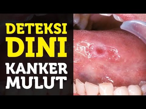 Penyebab Penyakit Kanker Mulut yang Perlu Diwaspadai, Jangan Abaikan