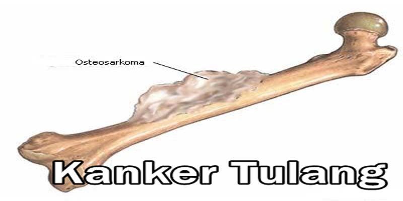 KANKER TULANG | JENIS, PENYEBAB, GEJALA DAN CIRI