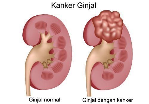 15 Ciri Ciri Kanker Ginjal : Penyebab Kanker Ginjal