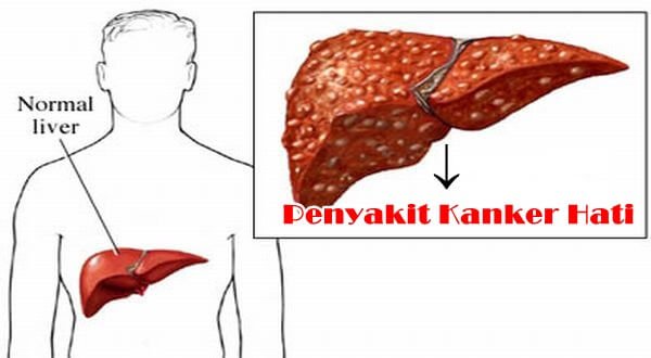 Penyebab dan Berbagai Faktor Risiko dari Kanker Hati (Liver)