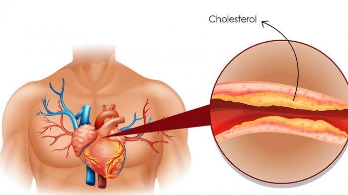 Kolesterol
